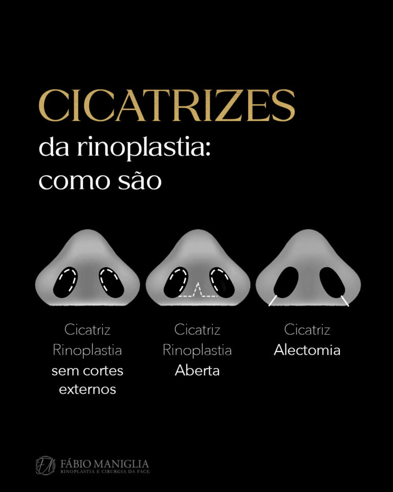 Como Fica A Cicatriz Da Rinoplastia Dr F Bio Maniglia