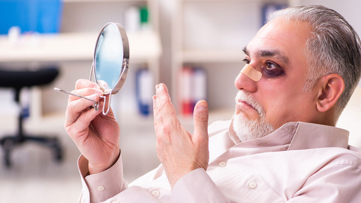 Olho Roxo Após Rinoplastia Por Que Algumas Pessoas Ficam Assim