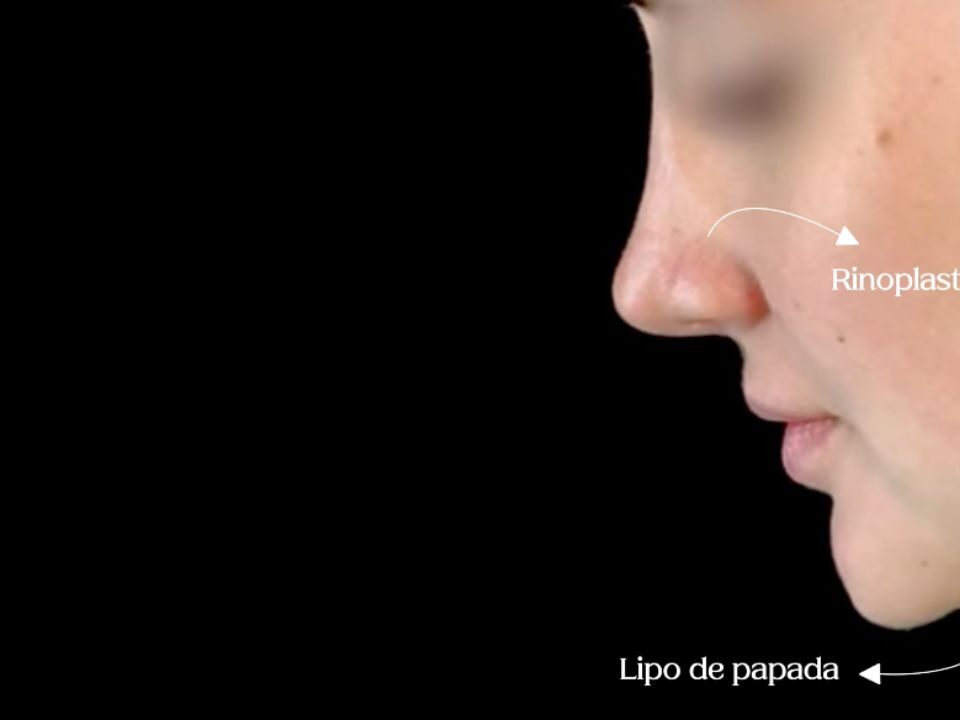 Rinoplastia e lipo de papada: uma combinação perfeita| Dr. Fábio Maniglia