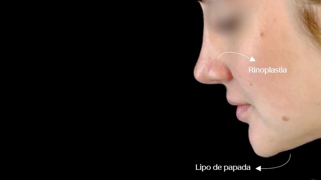 Rinoplastia e lipo de papada: uma combinação perfeita| Dr. Fábio Maniglia